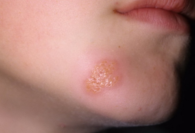 Co je opakující se herpes?